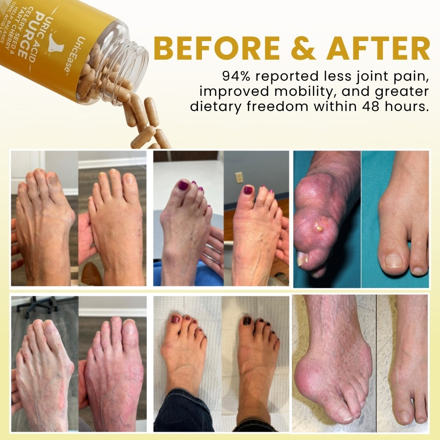 UricRelief™ | Daily Uric Acid & Joint Support Capsules